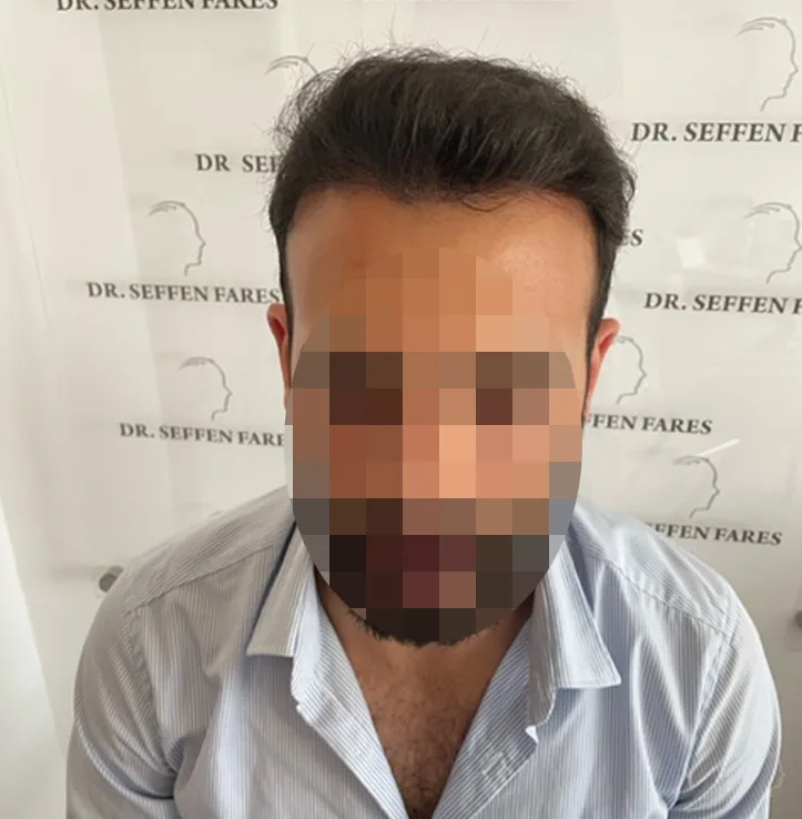 Patient 60 — 3,576 grafts · Norwood 4, after hair transplant