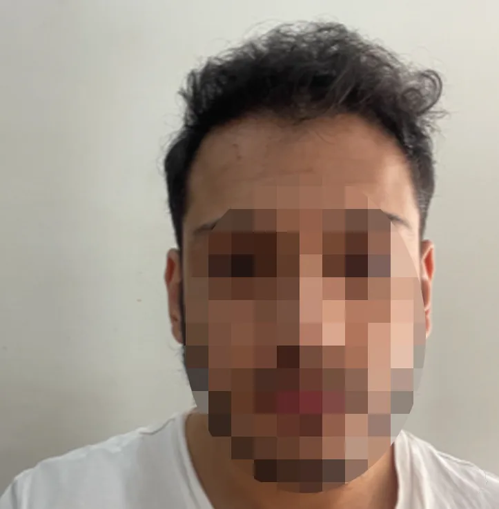 Patient 61 — 3,276 grafts · Norwood 5, after hair transplant