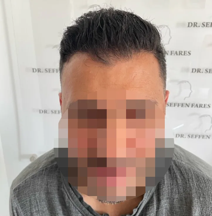 Patient 62 — 3,666 grafts · Norwood 4, after hair transplant