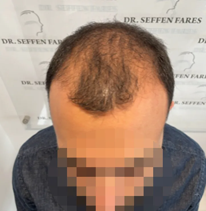 Patient 60 — 3,576 grafts · Norwood 4, before hair transplant