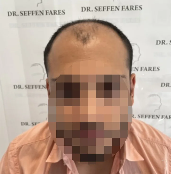 Patient 61 — 3,276 grafts · Norwood 5, before hair transplant