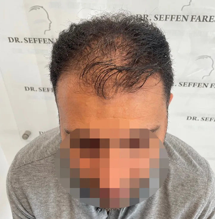 Patient 62 — 3,666 grafts · Norwood 4, before hair transplant