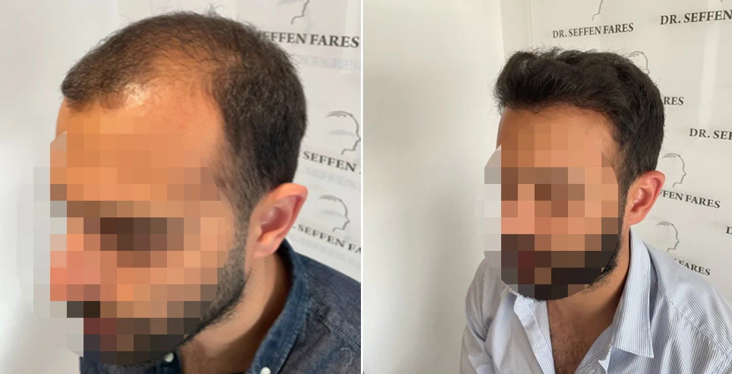 Patient 60, avant et après greffe de cheveux, vue 3