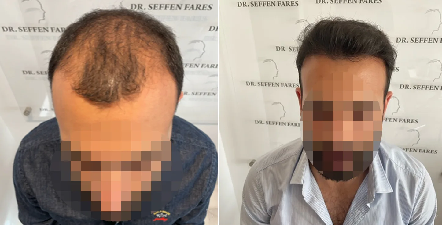 Patient 60, before and after hair transplant, view 1