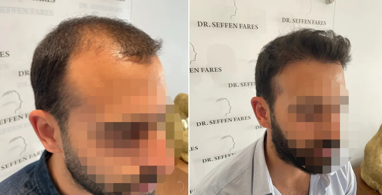 Patient 60, before and after hair transplant, view 2