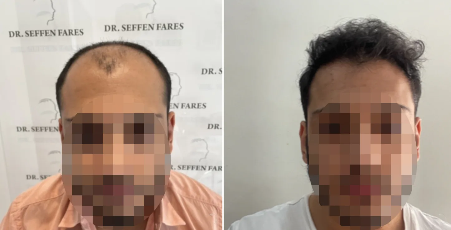 Patient 61, before and after hair transplant, view 1