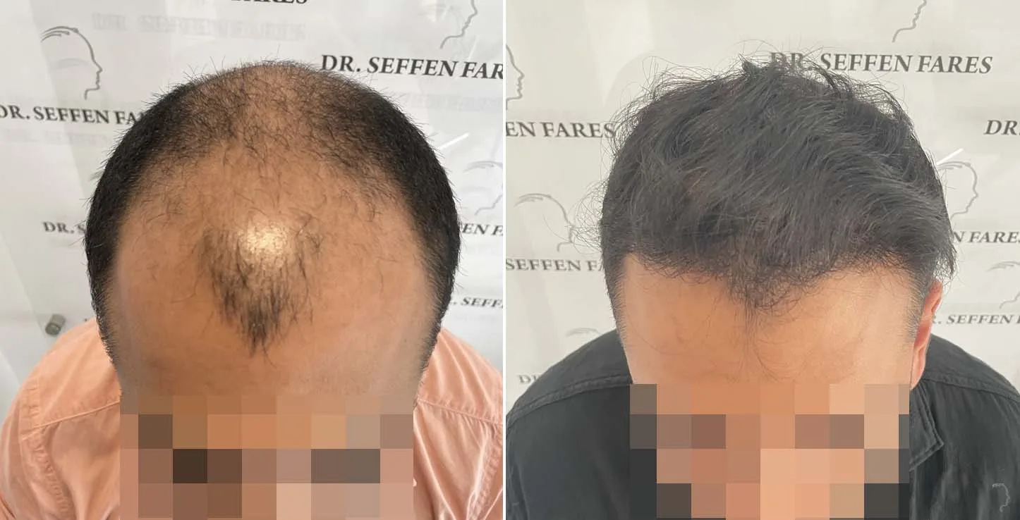 Patient 61, before and after hair transplant, view 3