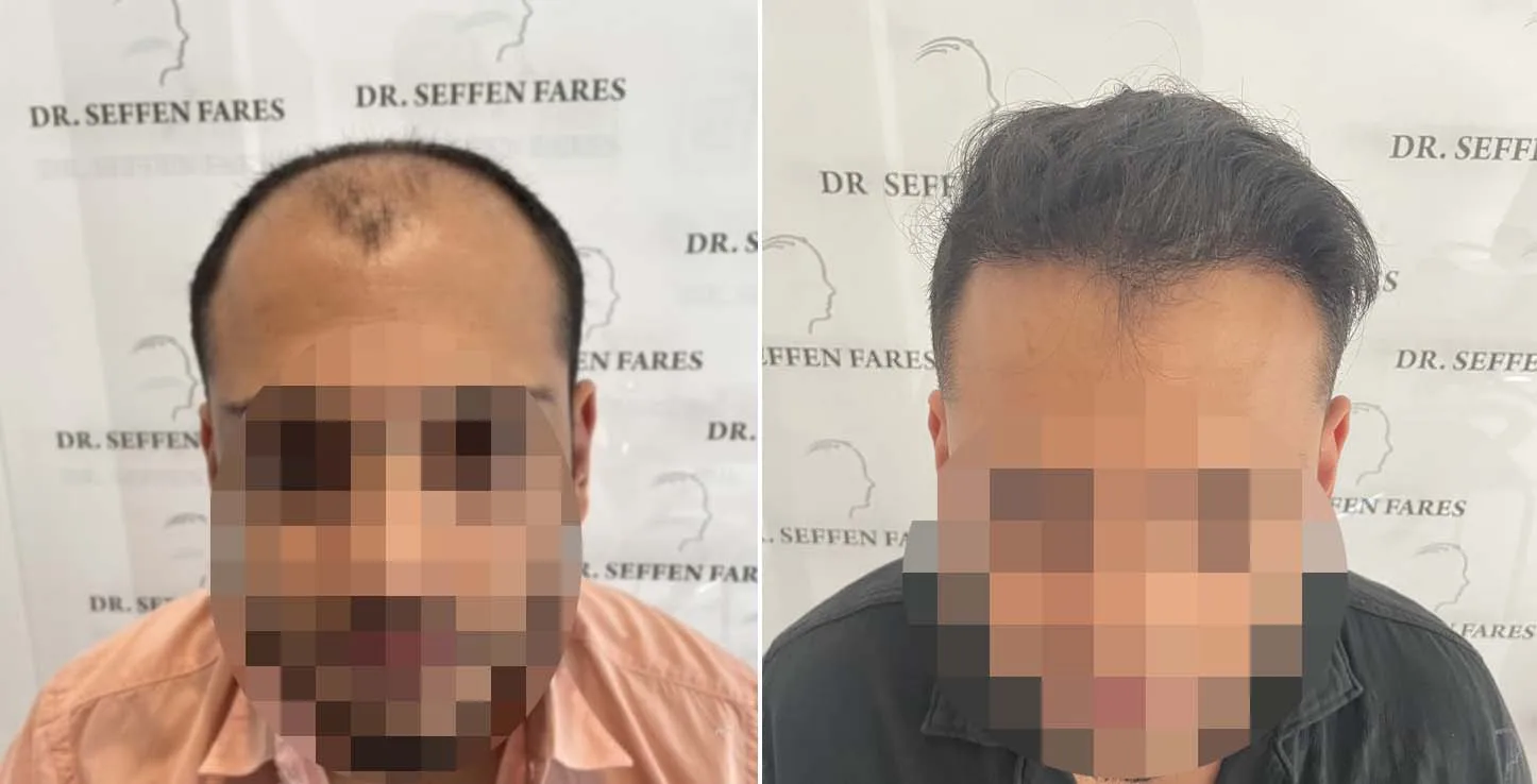 Patient 61, before and after hair transplant, view 4