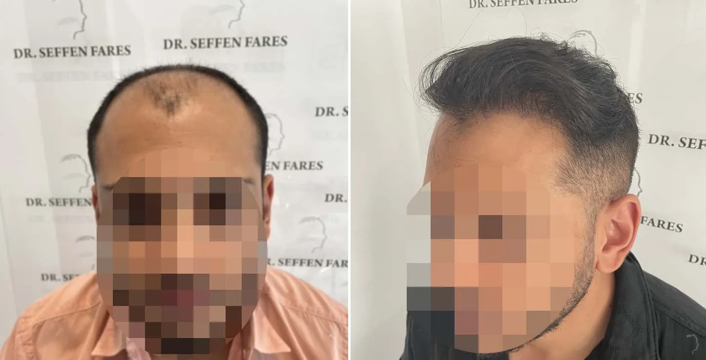 Patient 61, before and after hair transplant, view 5
