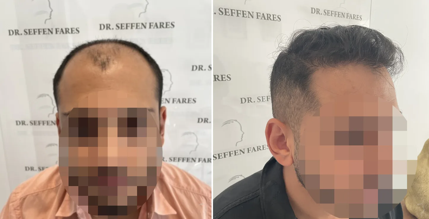 Patient 61, before and after hair transplant, view 6