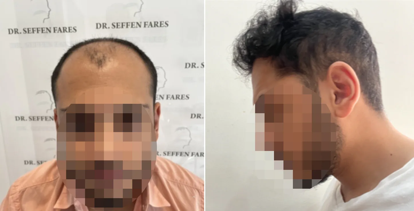 Patient 61, before and after hair transplant, view 2