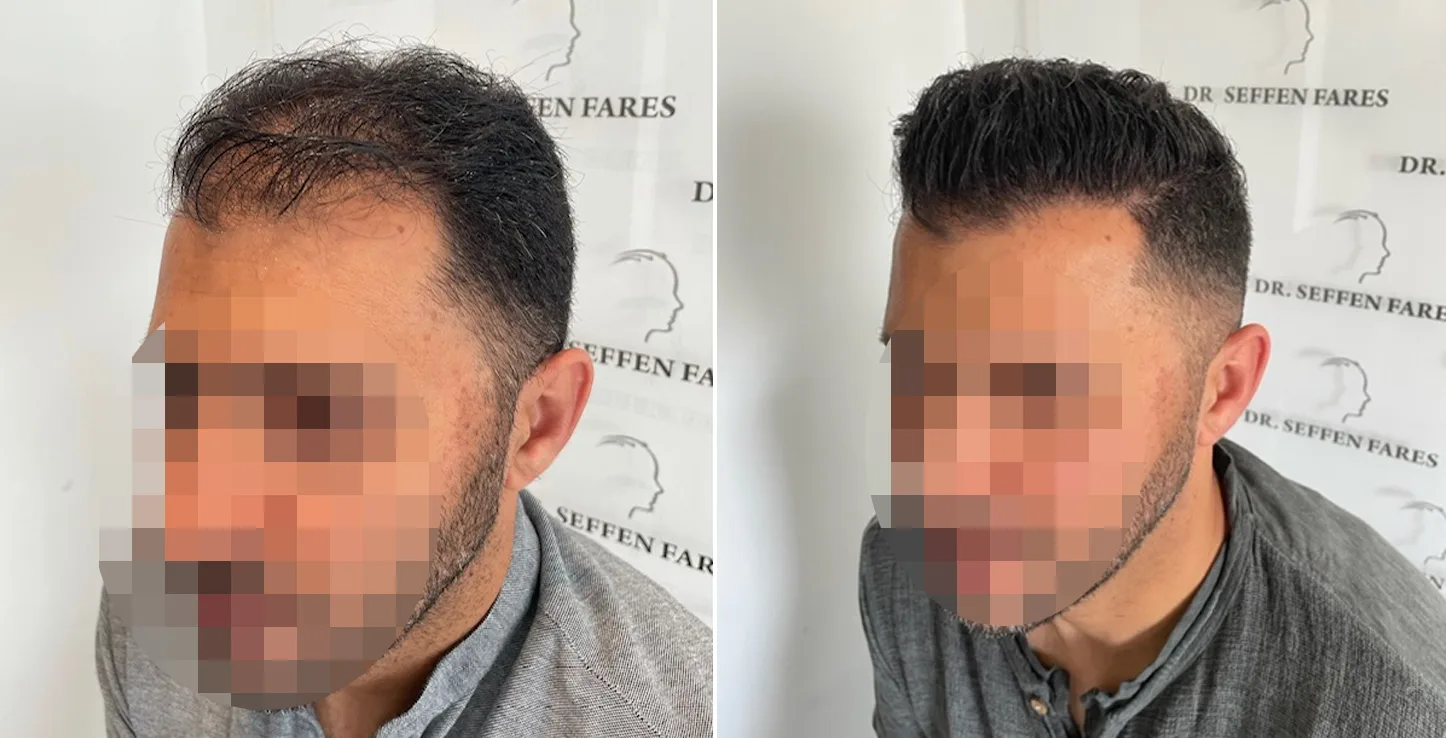 Patient 62, before and after hair transplant, view 2