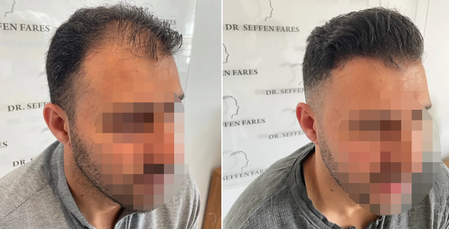 Patient 62, before and after hair transplant, view 3