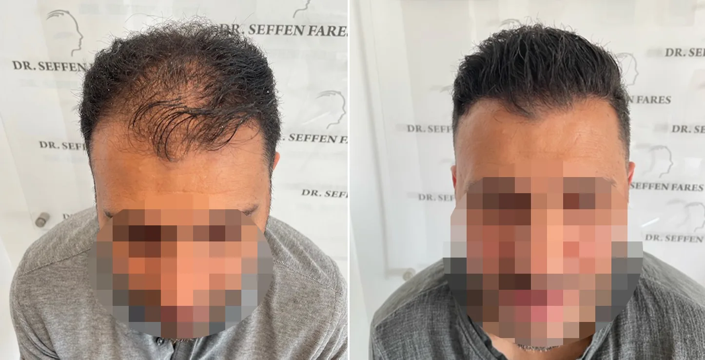 Patient 62, before and after hair transplant, view 1