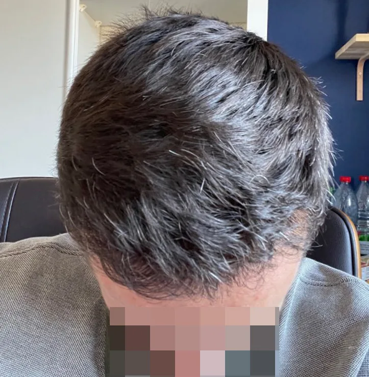 Patient 63, après greffe de cheveux