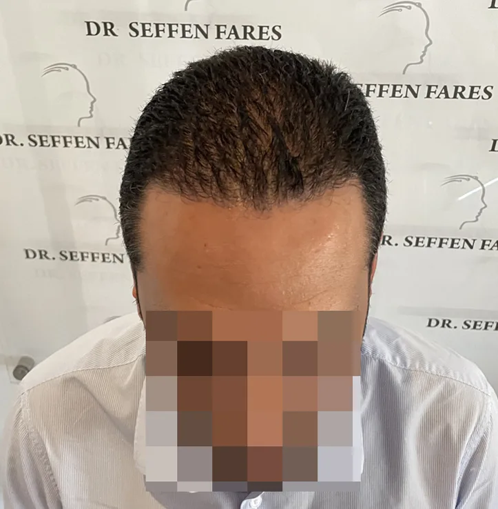 Patient 64, après greffe de cheveux