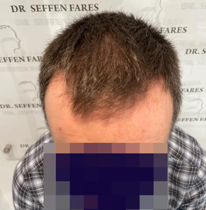 Patient 63, avant greffe de cheveux