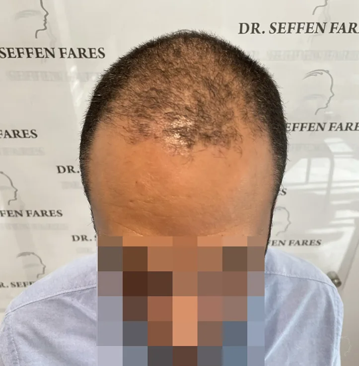 Patient 64, avant greffe de cheveux