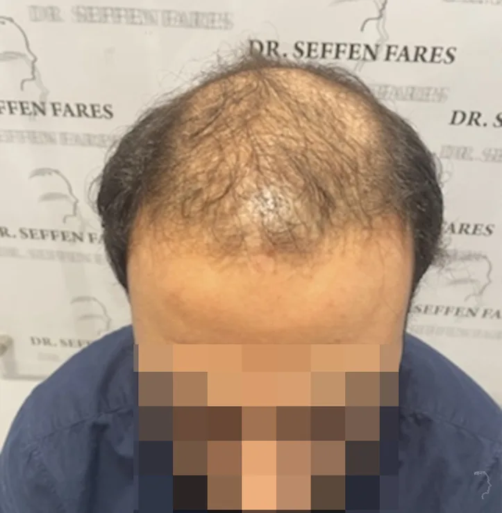 Patient 65, avant greffe de cheveux