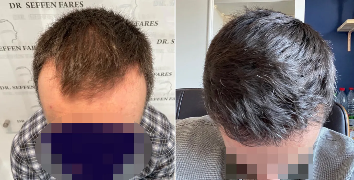 Patient 63, before and after hair transplant, view 1