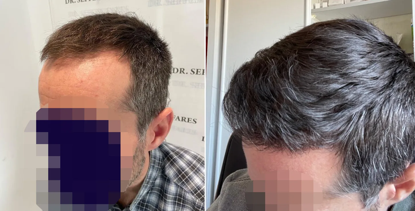 Patient 63, before and after hair transplant, view 3