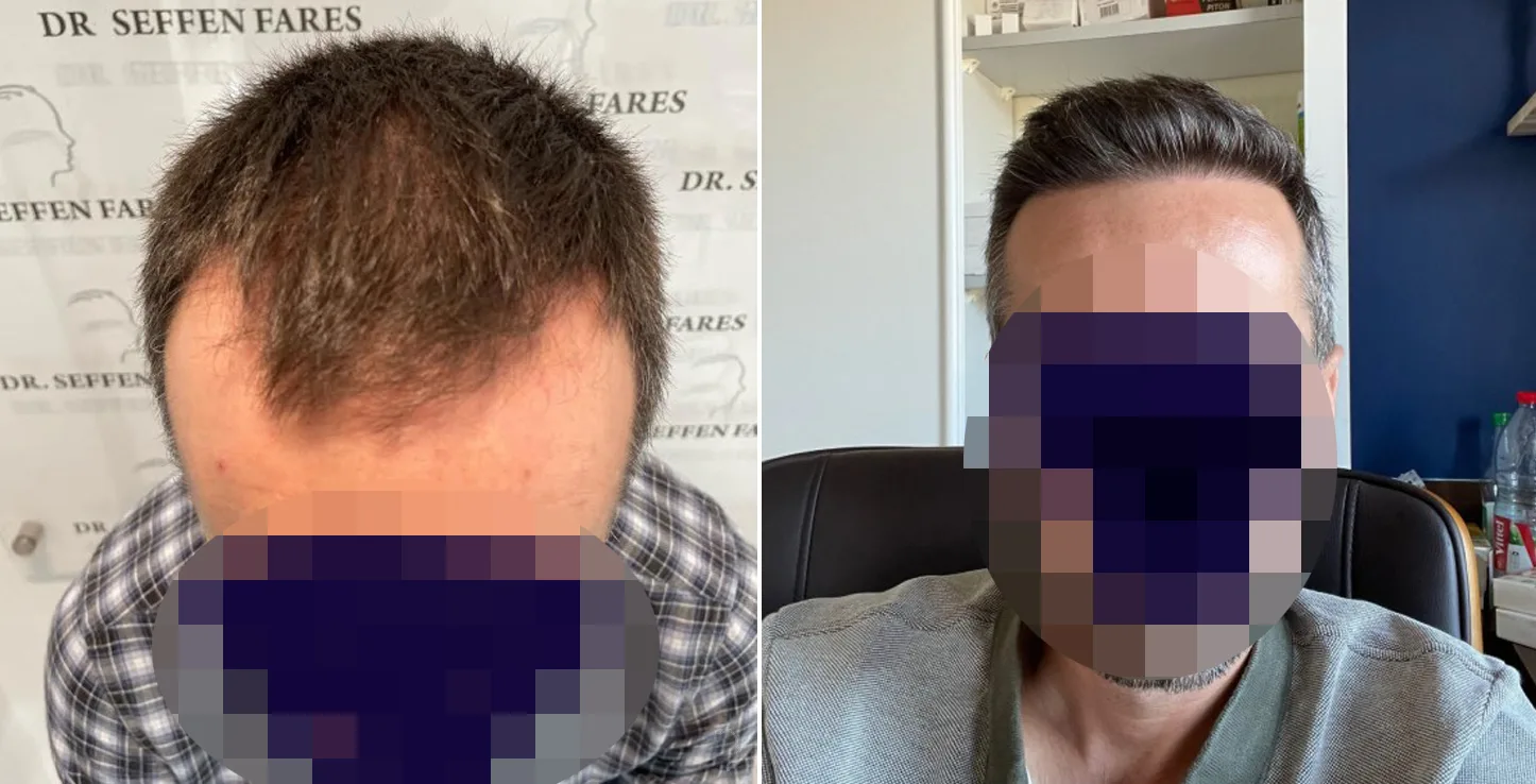 Patient 63, before and after hair transplant, view 4