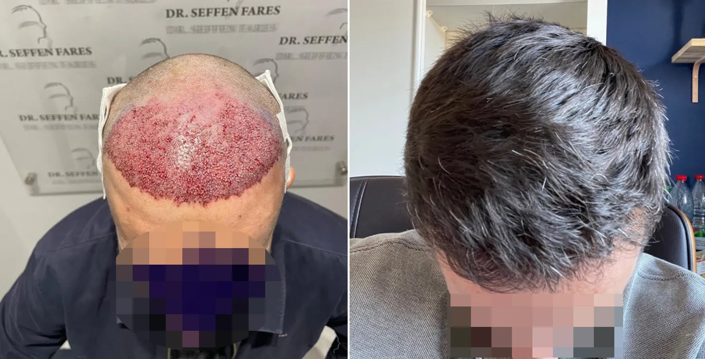 Patient 63, before and after hair transplant, view 2