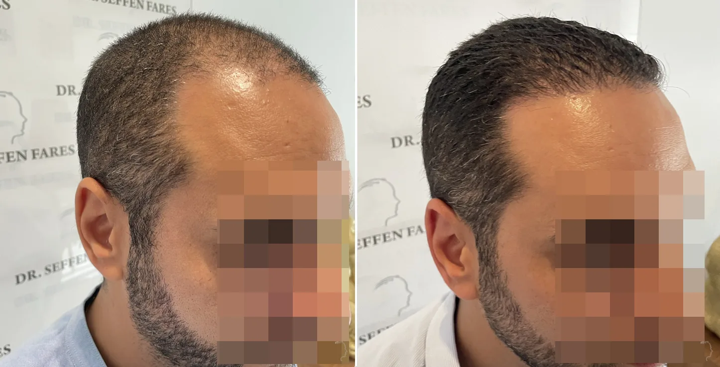 Patient 64, before and after hair transplant, view 2