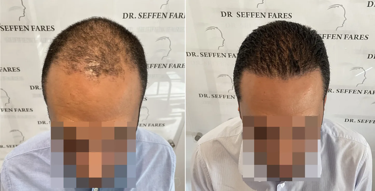 Patient 64, before and after hair transplant, view 1