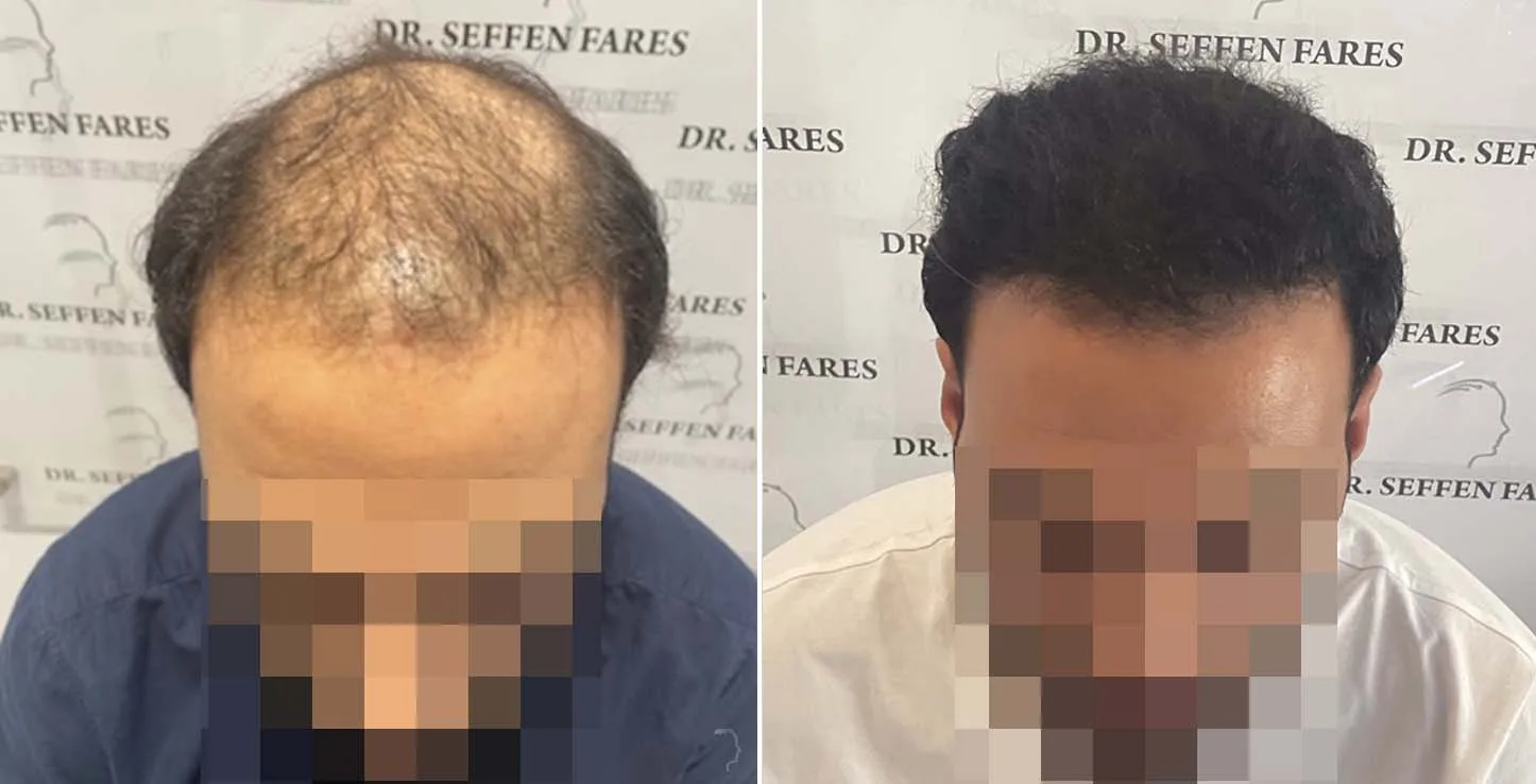 Patient 65, before and after hair transplant, view 1