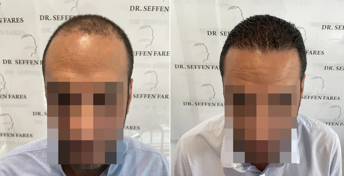 Patient 64, before and after hair transplant, view 3