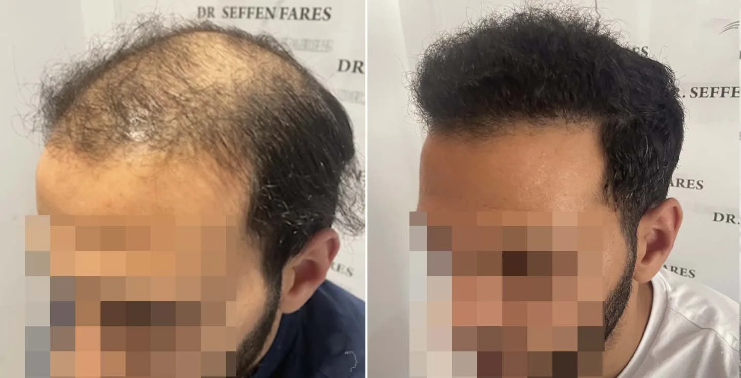 Patient 65, before and after hair transplant, view 2