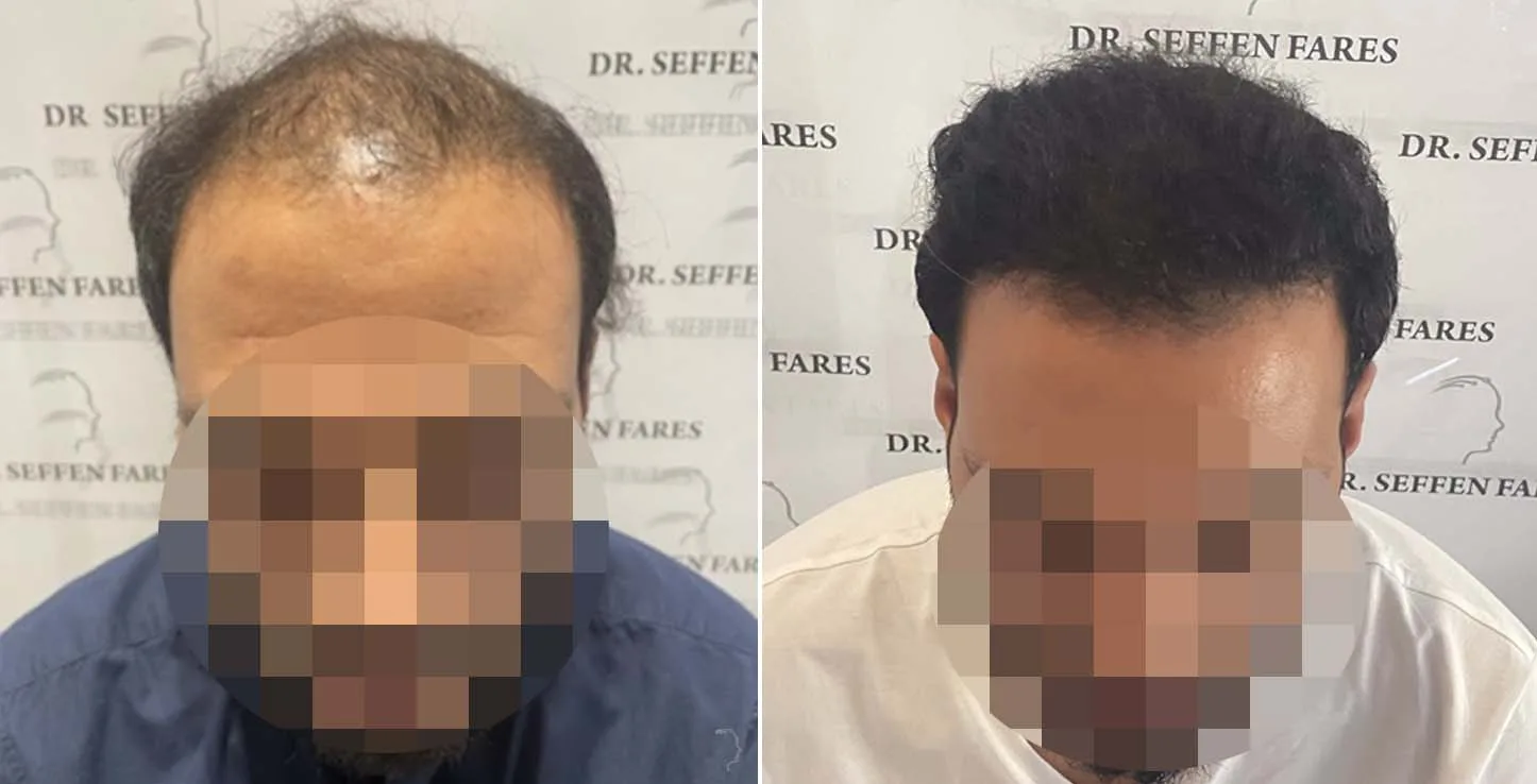 Patient 65, before and after hair transplant, view 4