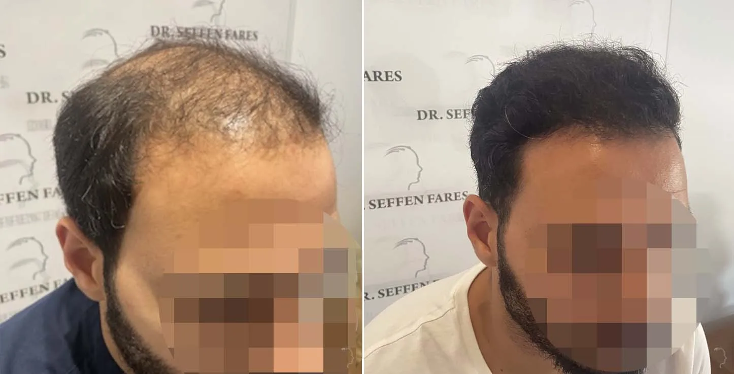 Patient 65, before and after hair transplant, view 3