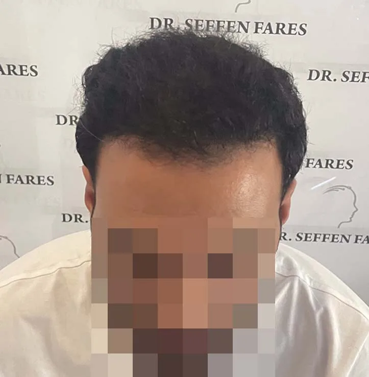 Patient 65, après greffe de cheveux