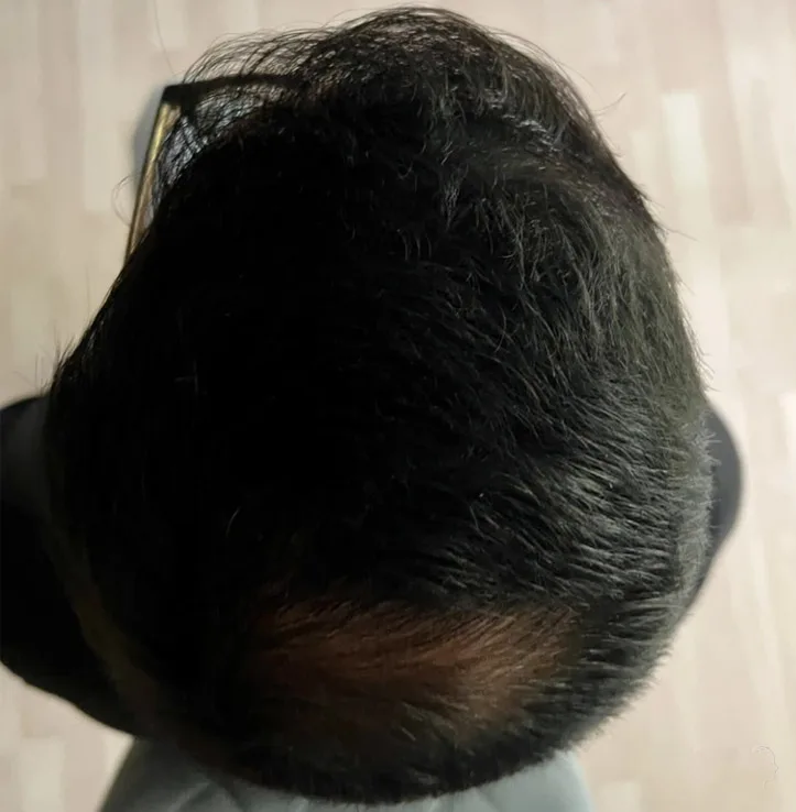 Patient 66, après greffe de cheveux