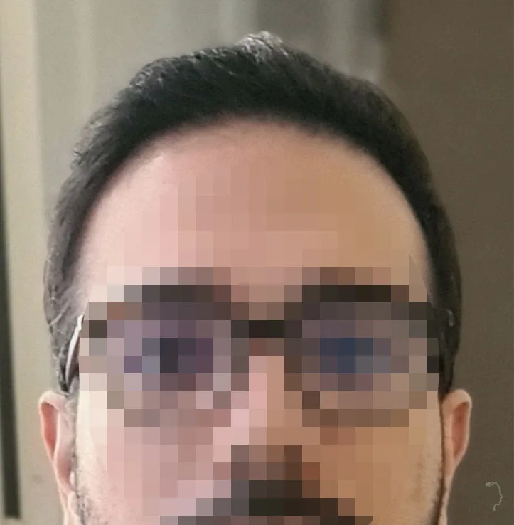 Patient 67, après greffe de cheveux
