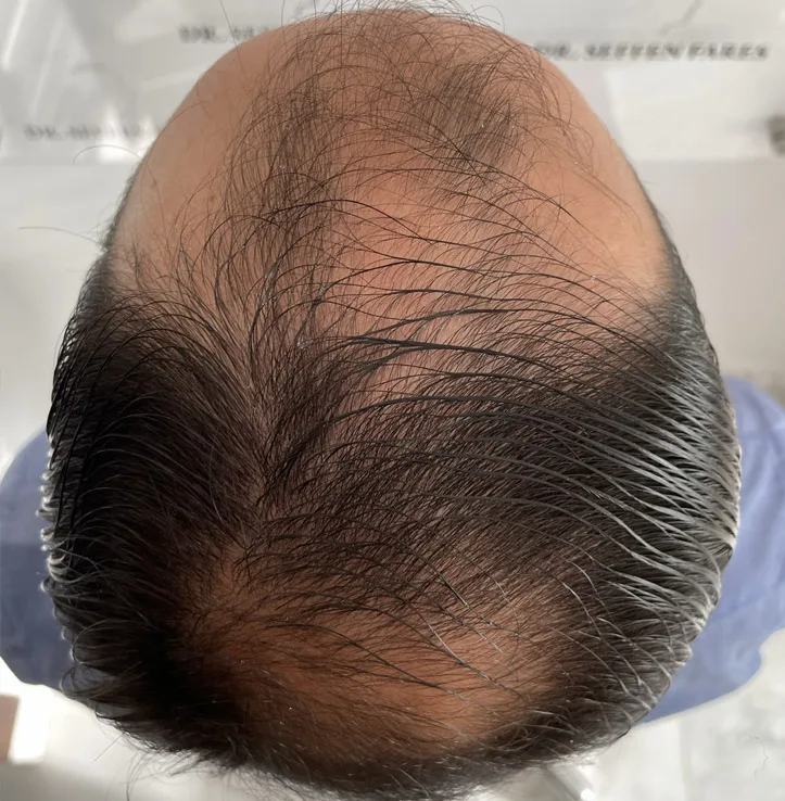 Patient 66, avant greffe de cheveux