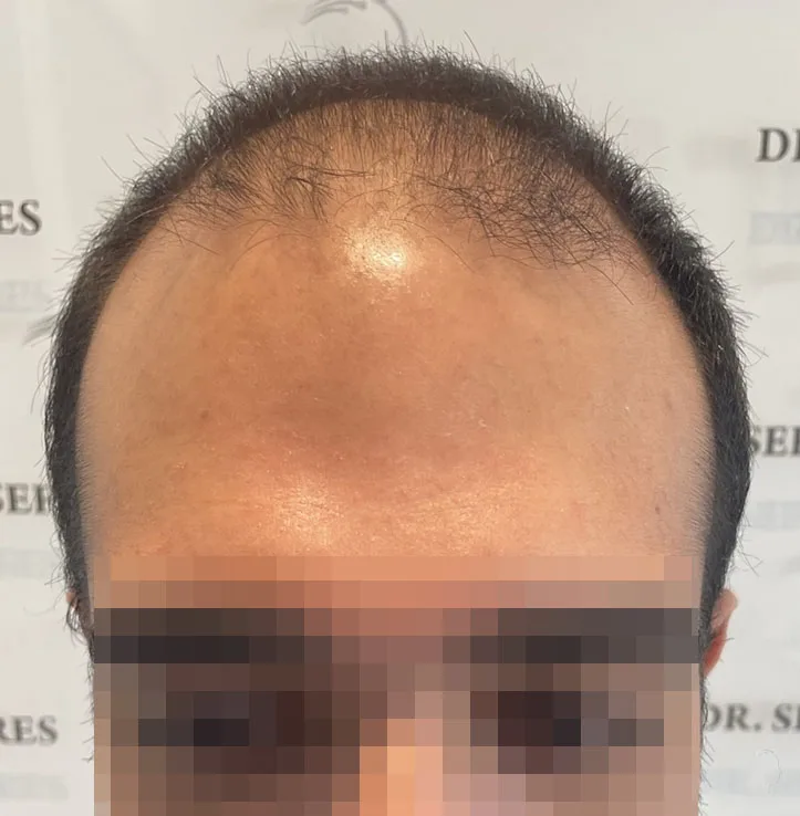 Patient 67, avant greffe de cheveux
