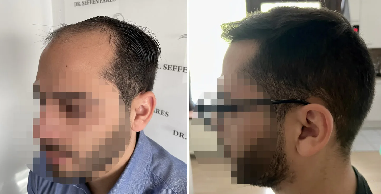 Patient 66, before and after hair transplant, view 3
