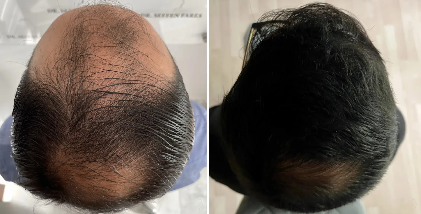 Patient 66, before and after hair transplant, view 1