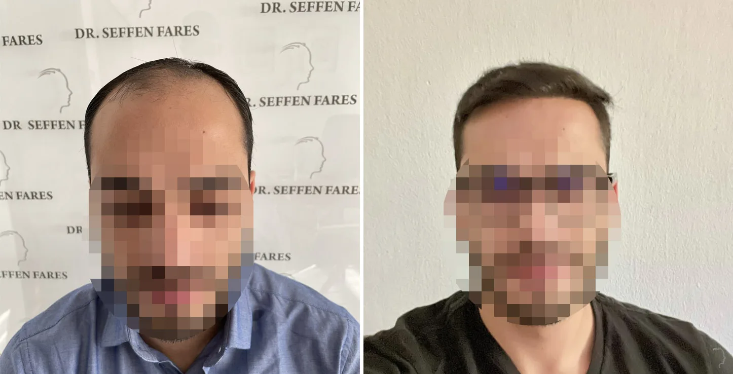 Patient 66, before and after hair transplant, view 2
