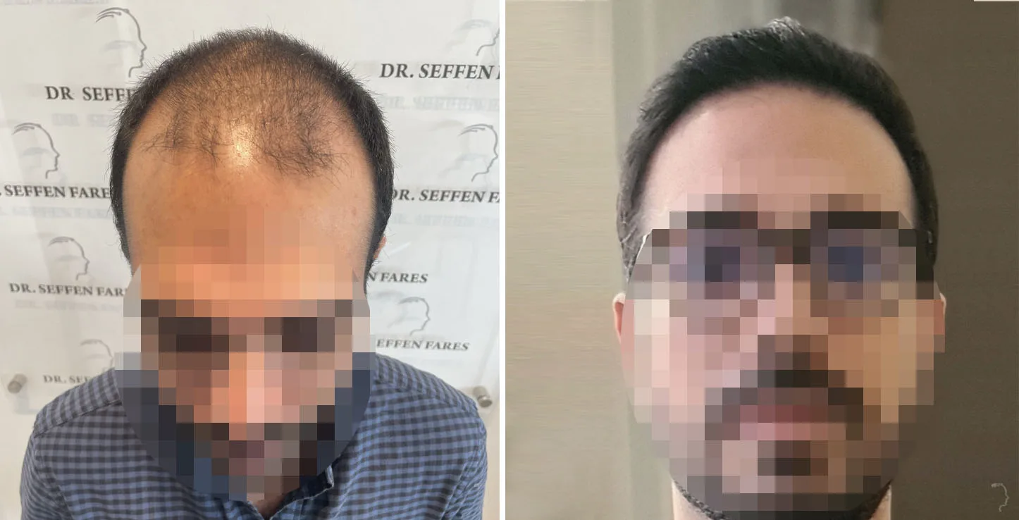 Patient 67, before and after hair transplant, view 2