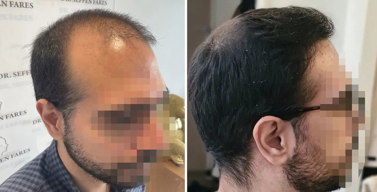 Patient 67, before and after hair transplant, view 1