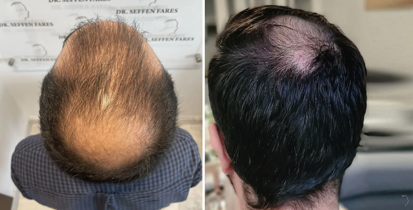 Patient 67, before and after hair transplant, view 4