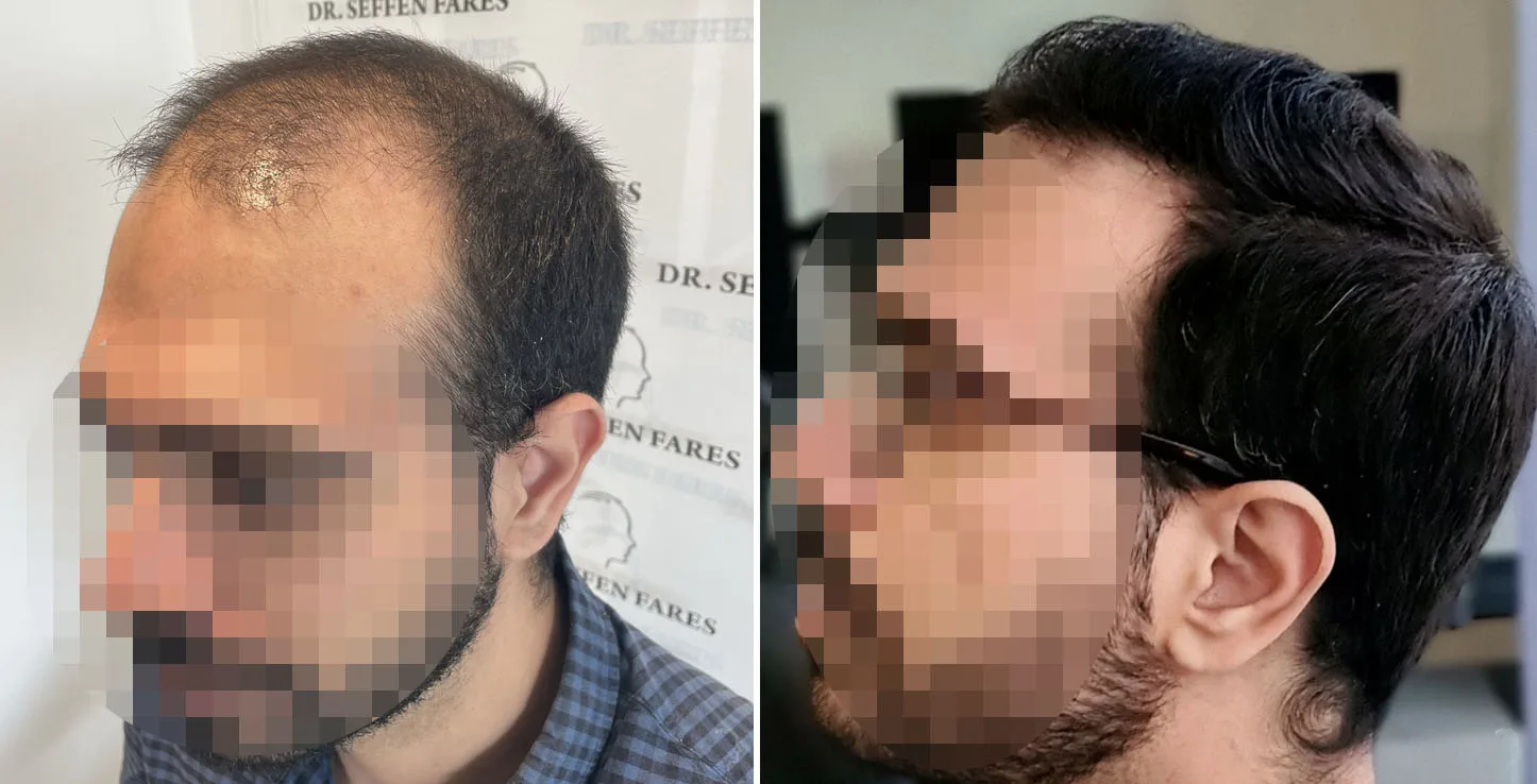 Patient 67, before and after hair transplant, view 3