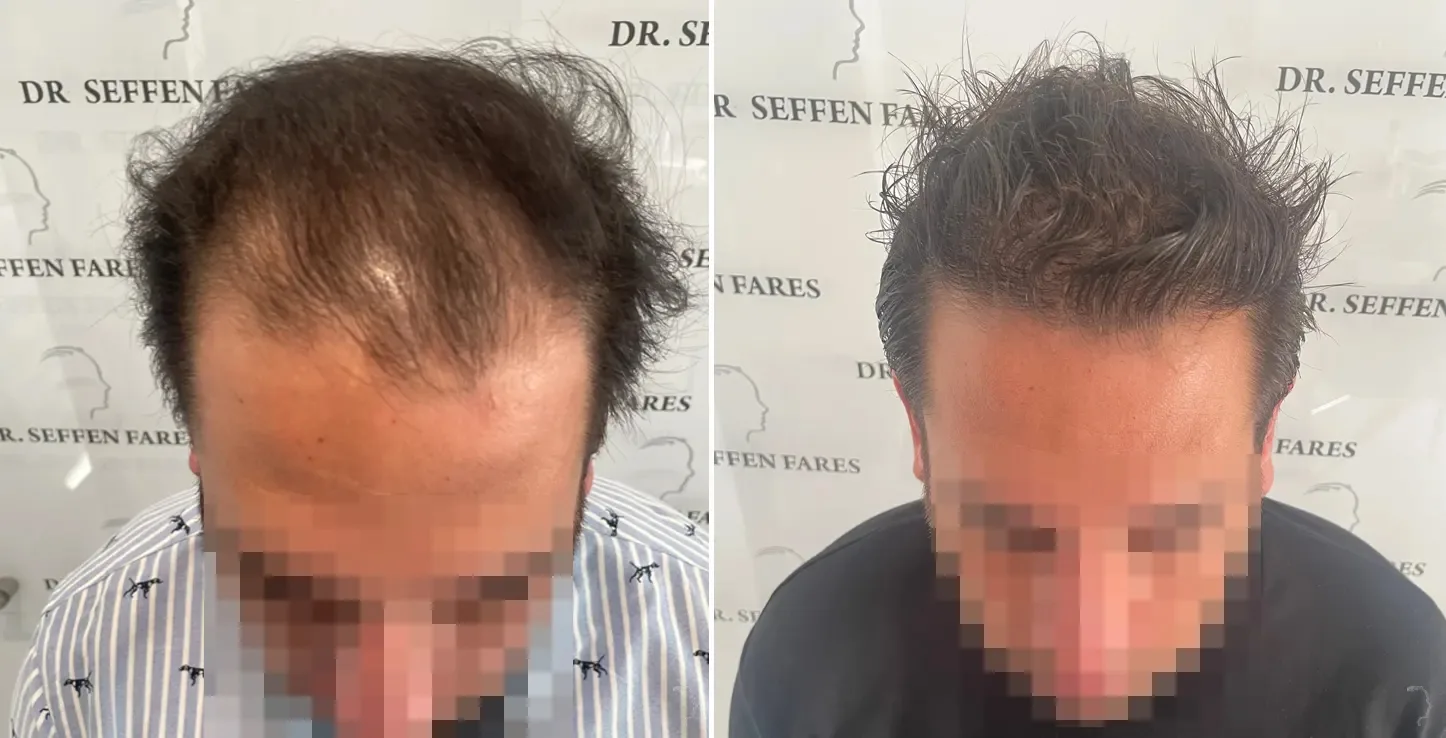 Patient 68, before and after hair transplant, view 1
