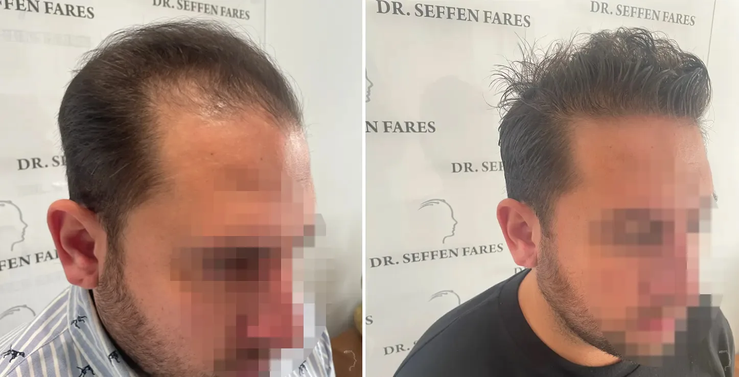 Patient 68, before and after hair transplant, view 3