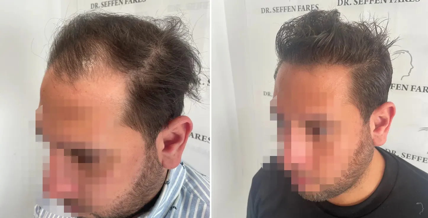 Patient 68, before and after hair transplant, view 2