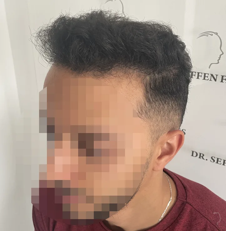 Patient 69, après greffe de cheveux